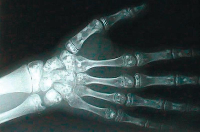 Primul caz de osteopoikiloză descris în România
