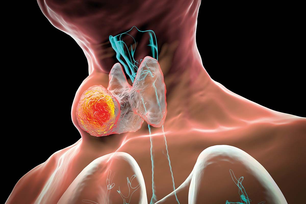 Evaluarea nodulilor tiroidieni