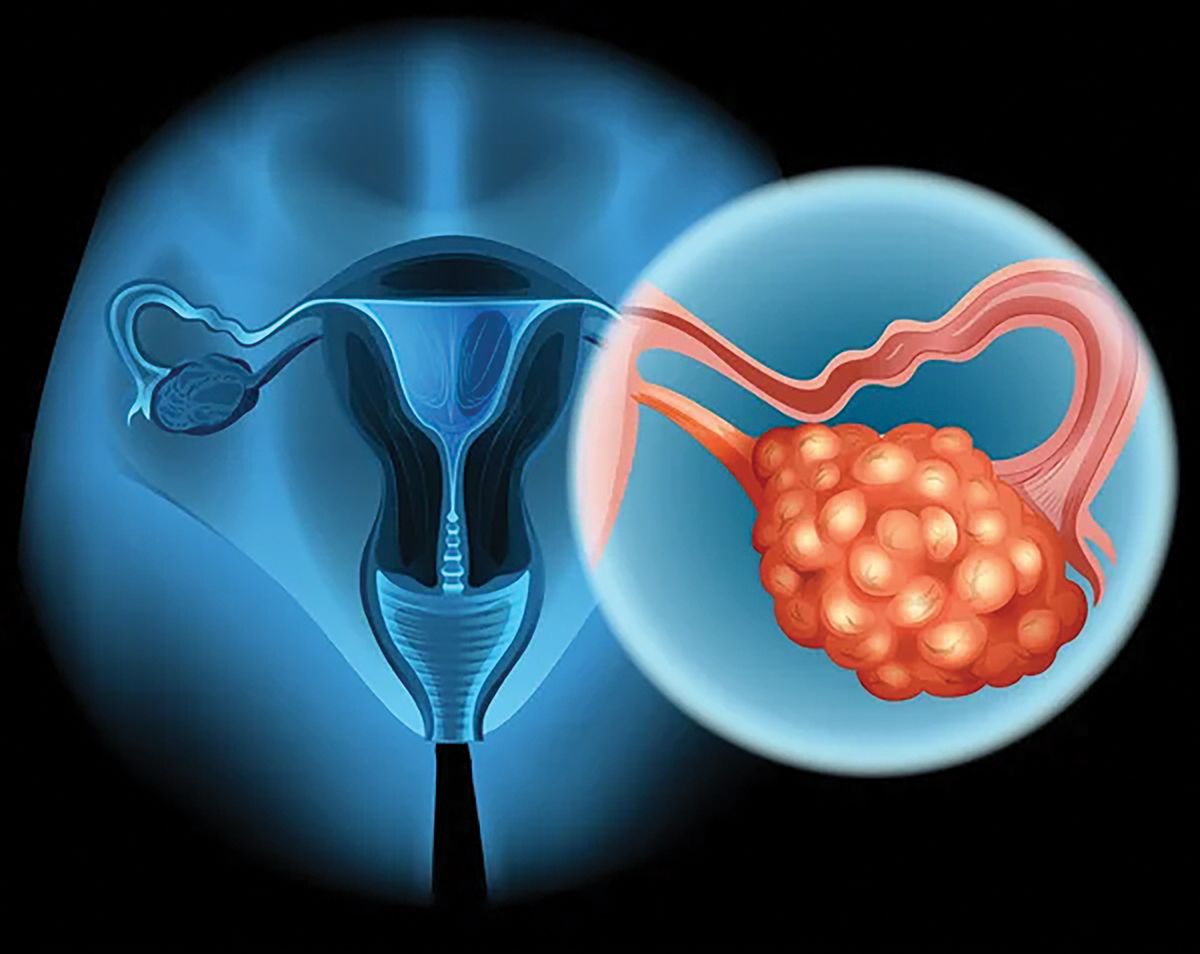 Dr. Daniela Zob: 70% din cazurile de cancer ovarian sunt depistate în stadii avansate
