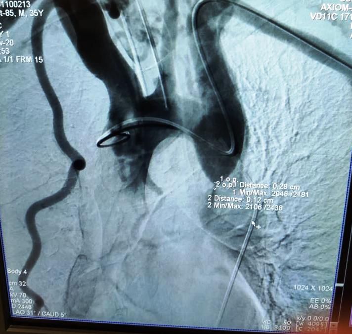 Premieră medicală - Intervenție de implantare de stent aortic la un pacient diagnosticat cu Coarctație de aortă (3)