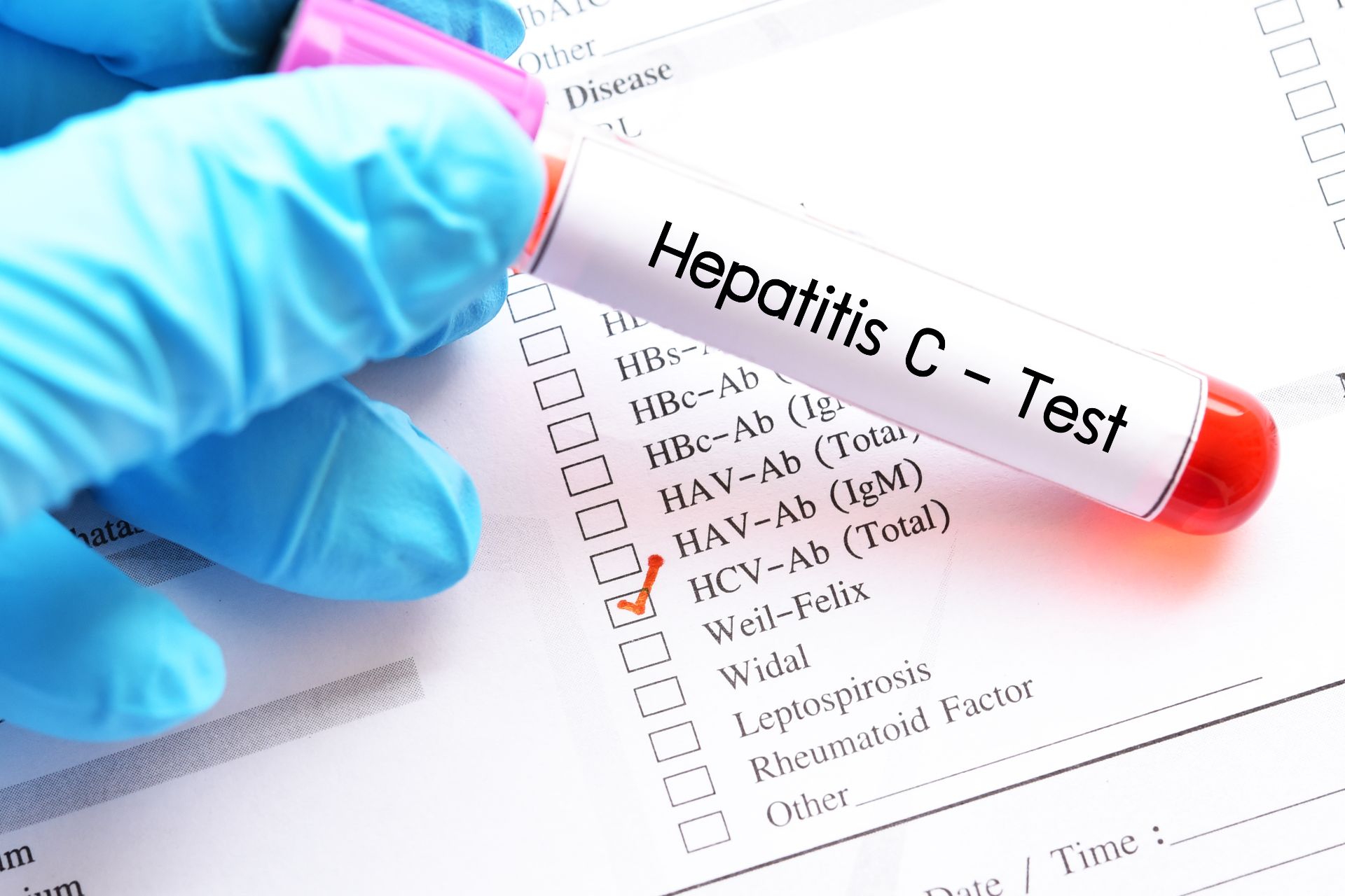Test hepatita