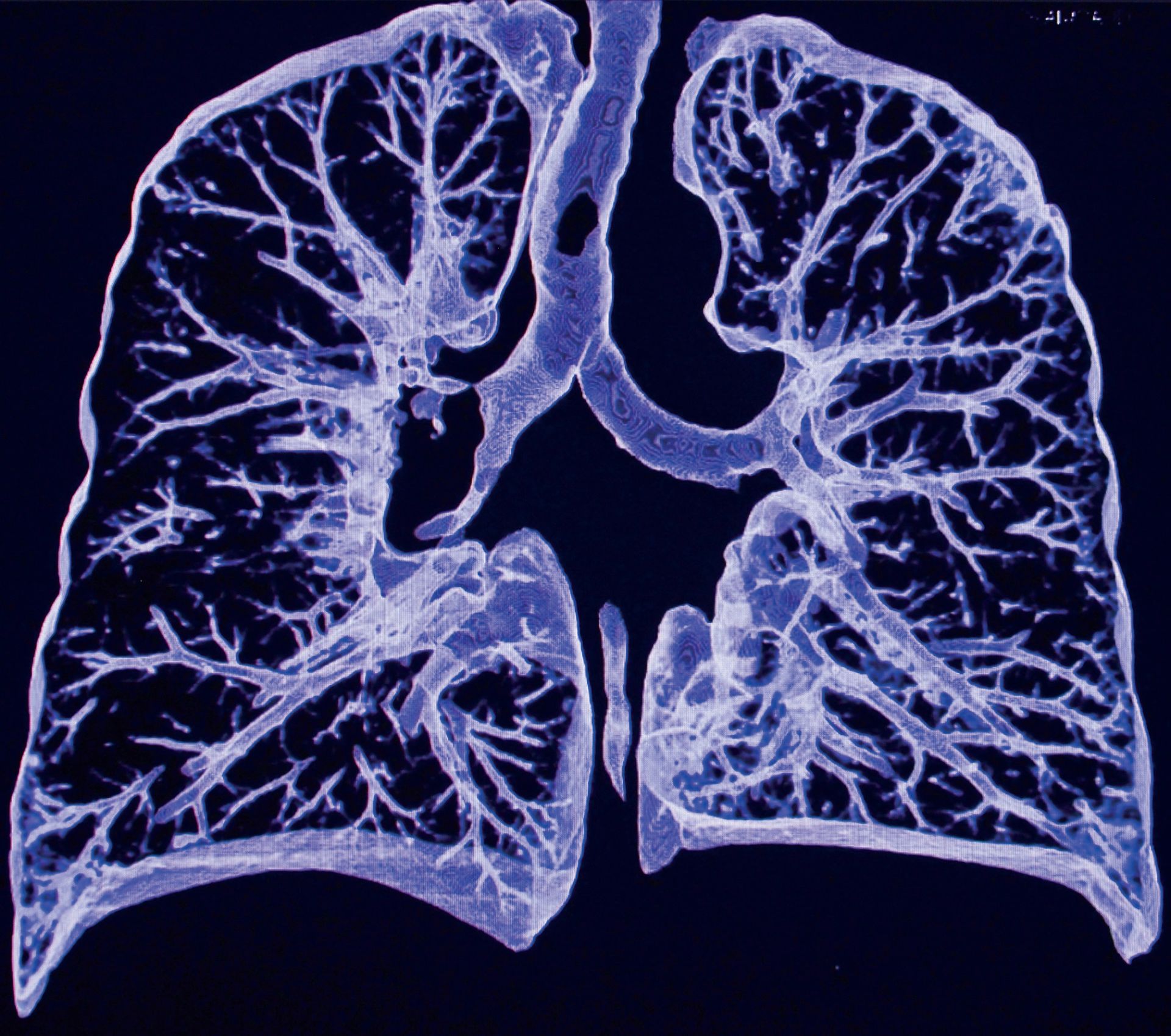 cancerul pulmonar