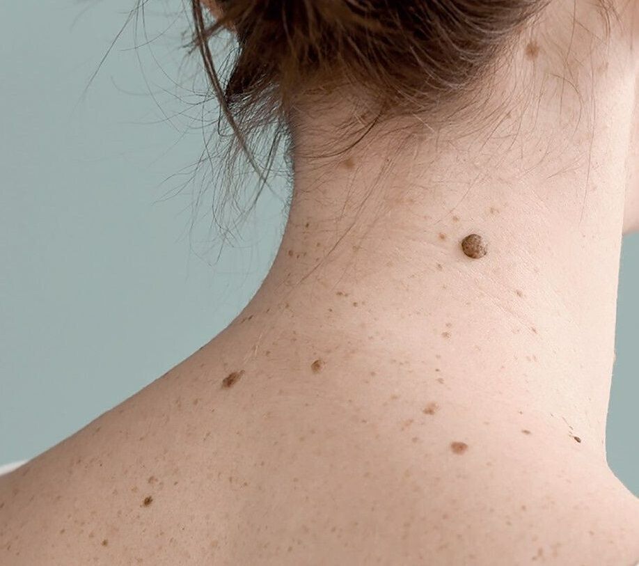 Dr. Mihaela Leventer: de ce a crescut incidența cancerului de piele