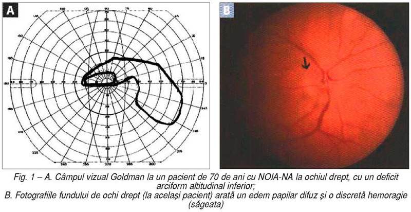 Neuropatia optică ischemică anterioară non-arteritică