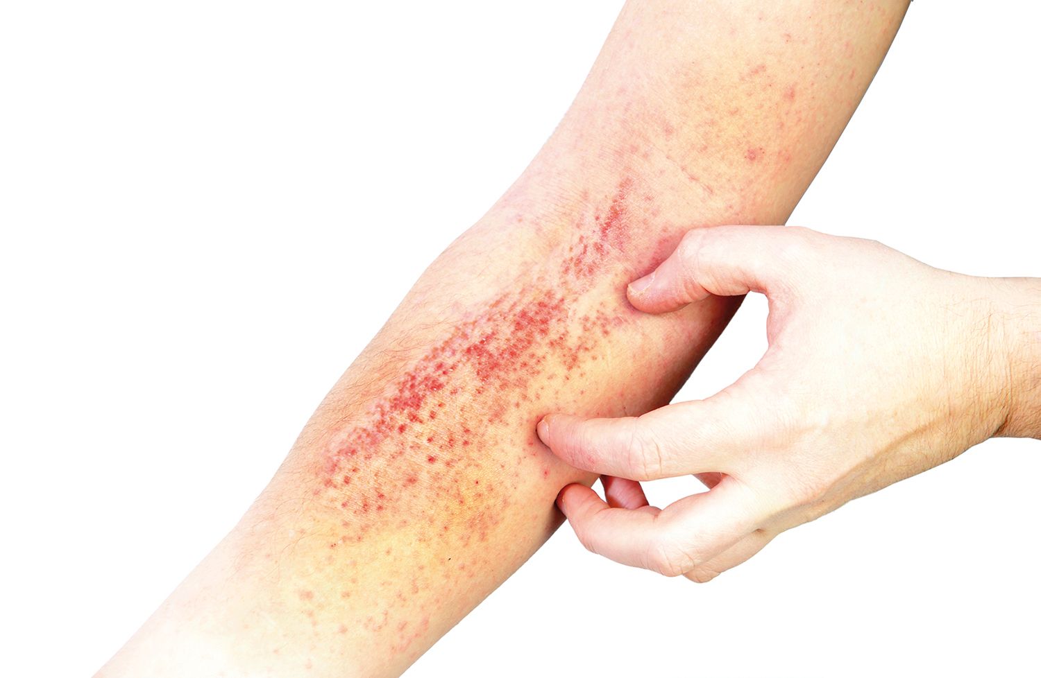 Dermatita atopică și evaluarea leziunilor cutanate