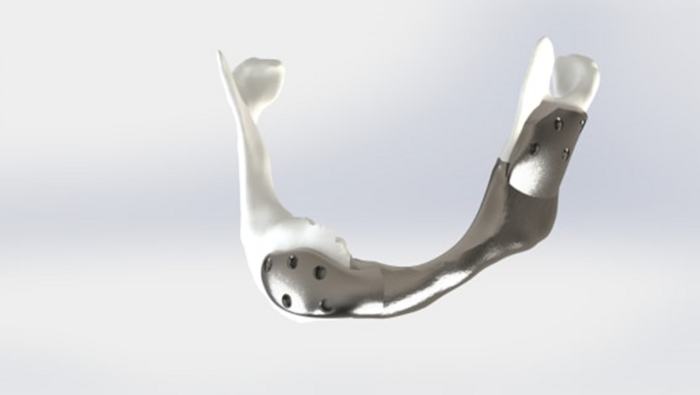 implant-mandibula