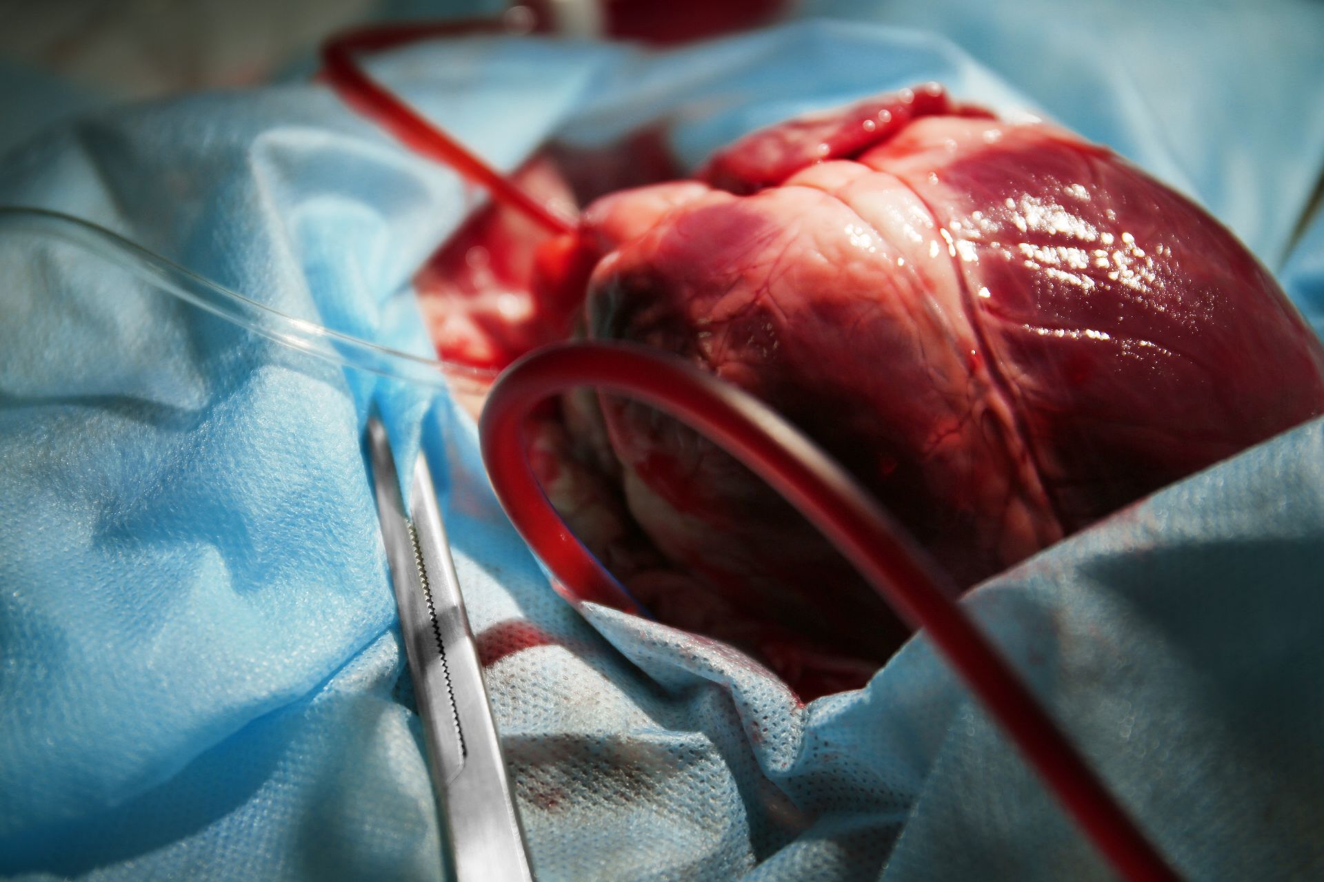 Primul transplant cardiac din acest an