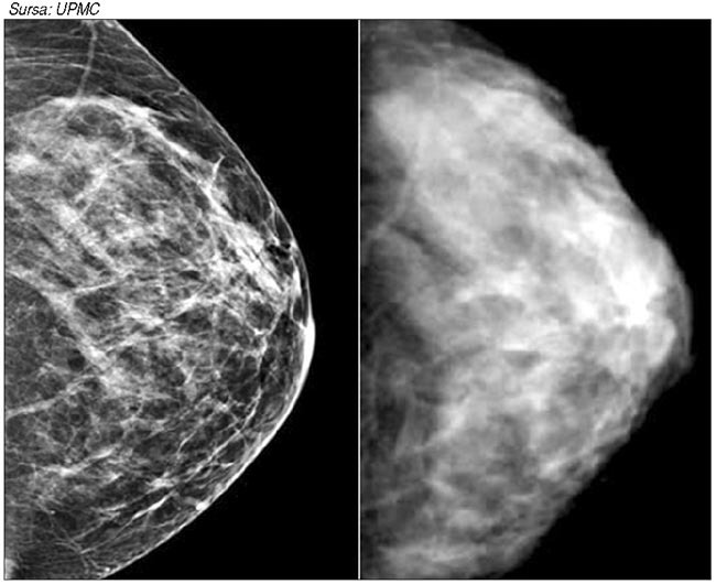 Centenarul mamografiei