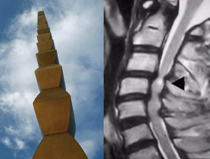 Sănătatea coloanei vertebrale