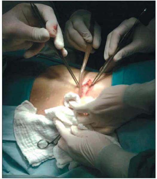 Actualităţi în tratamentul ortopedico-chirurgical al morbului Pott