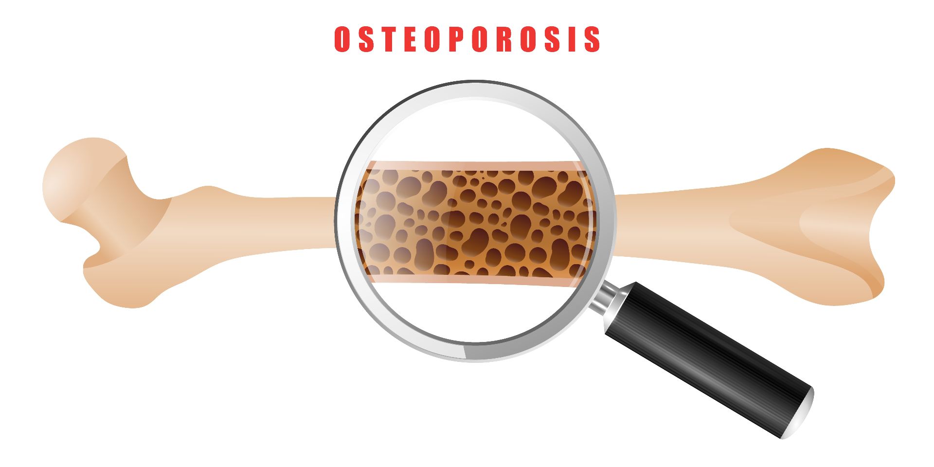 Dozele mari de statine cresc riscul de osteoporoză