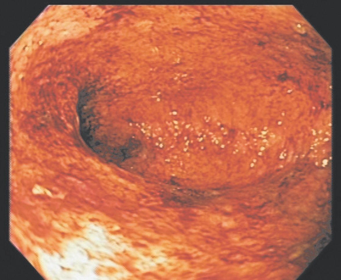 Diagnosticul endoscopic al colitei ulcerative