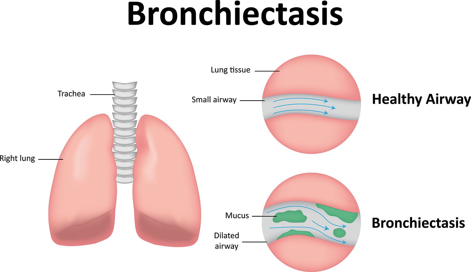 Bronșiectaziile  non-fibrochistice,  o nouă opţiune terapeutică