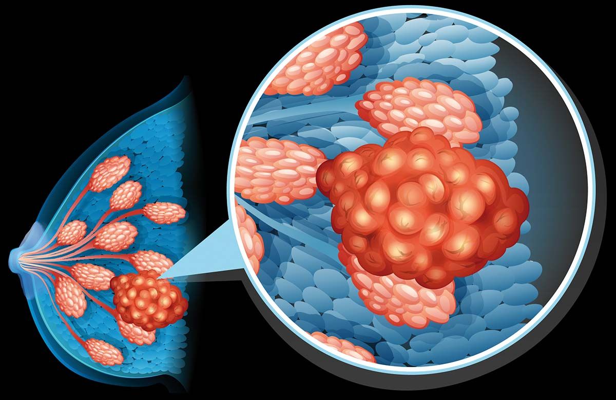 Terapia cu ribociclib și letrozol în cancerul de sân