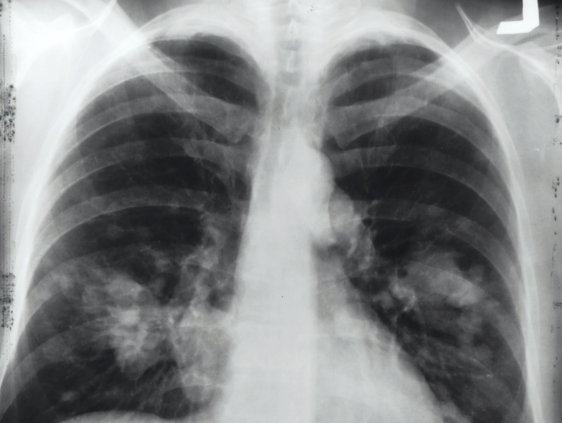 radiografie-plamani