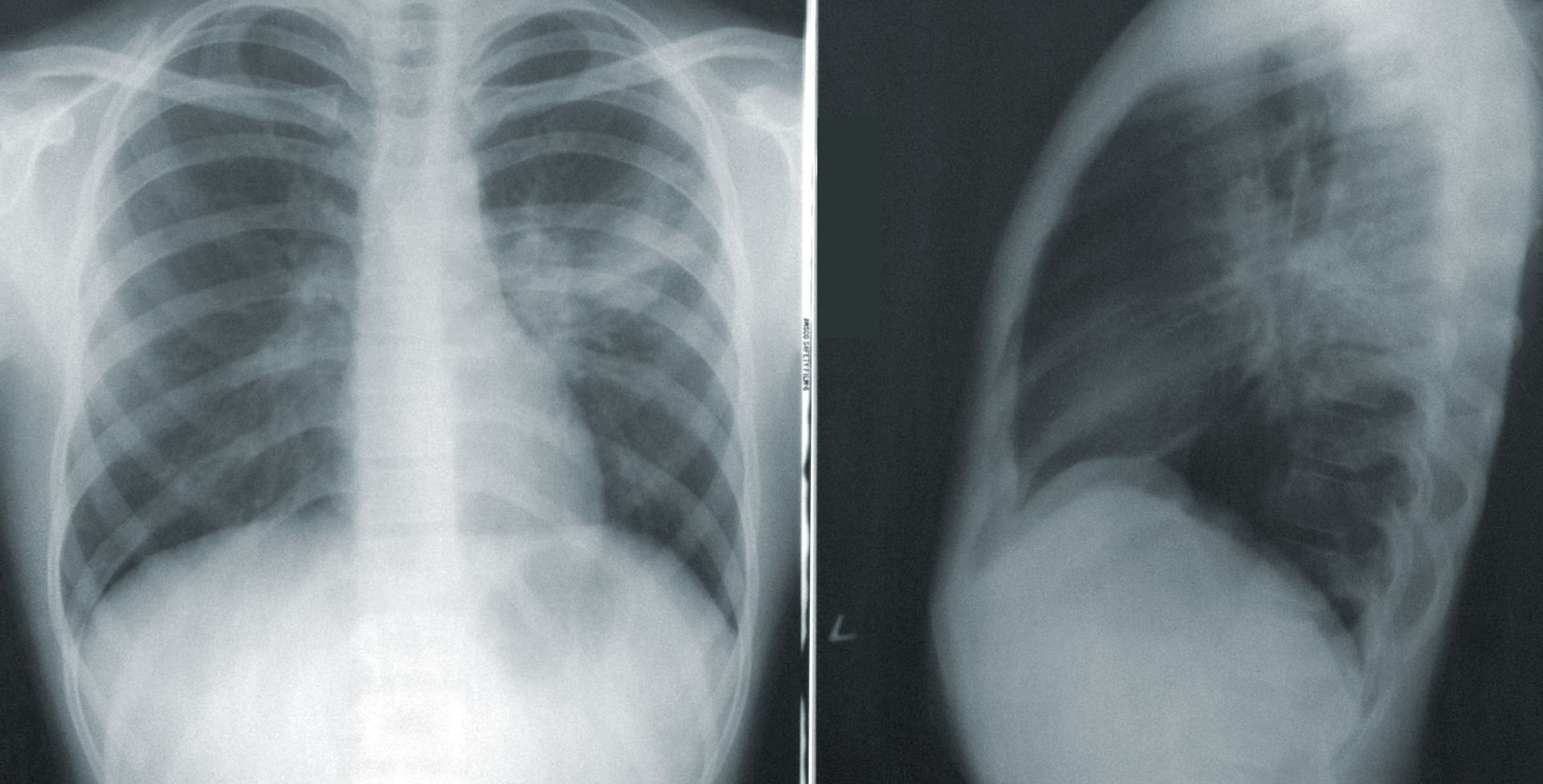 radiografie-plamani-bilaterala