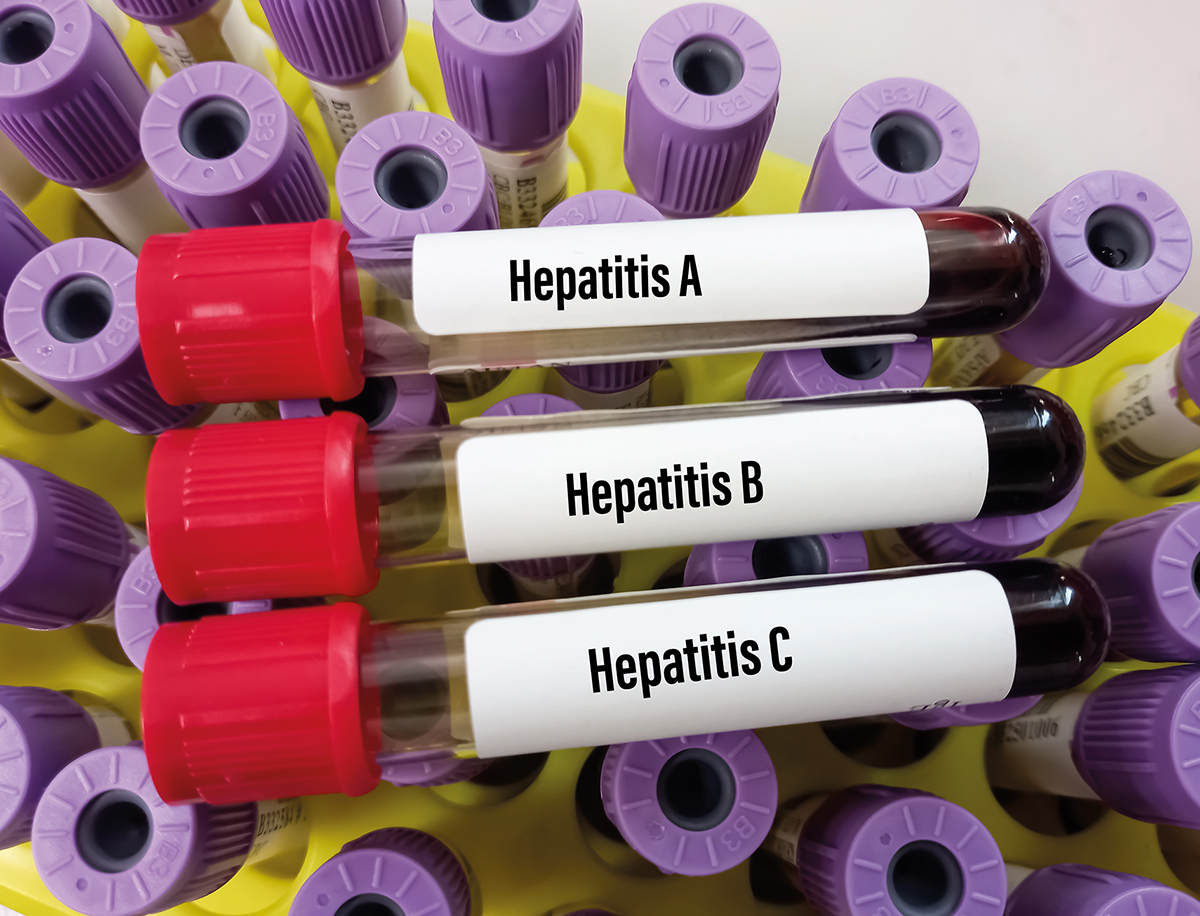 Hepatita C poate fi eliminată prin acces neîngrădit la tratament