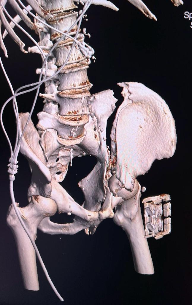 Prima intervenţie de osteosinteză cu machetă 3D preoperator, la Spitalul Judeţean de Urgenţă Târgu Mureş 