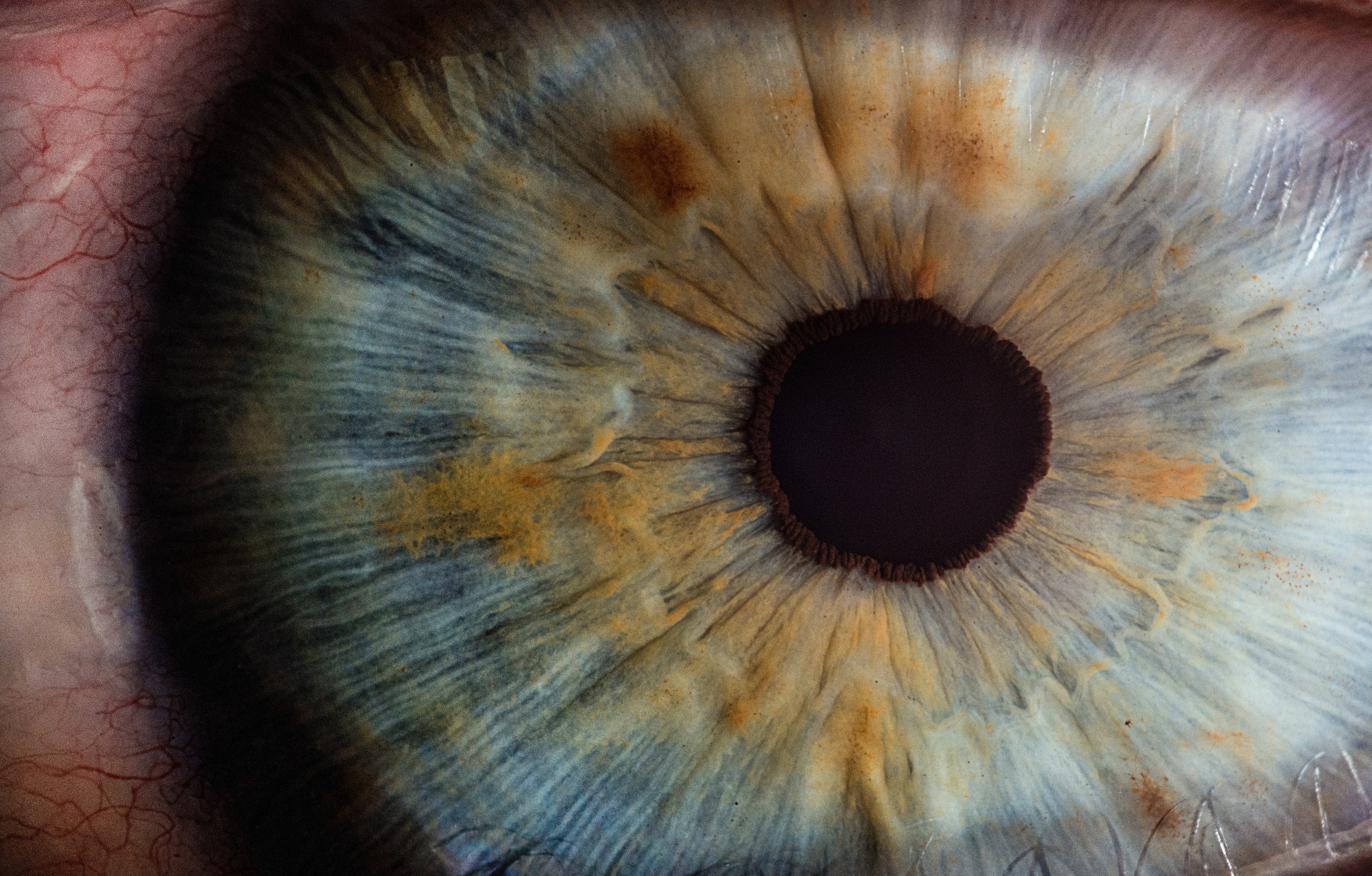 Premieră mondială: transplantul unui ochi complet, realizat în SUA