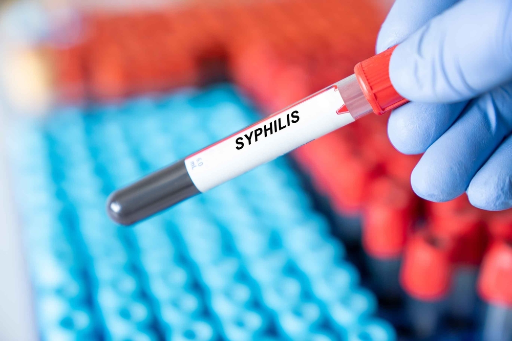 Numărul cazurilor de sifilis înregistrate în SUA este tot mai mare